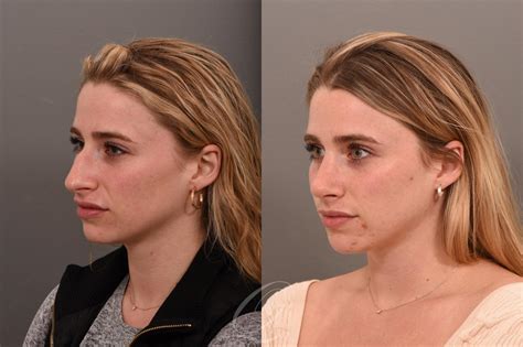 Rhinoplasty Before & After Photos Patient 1001617 | Serving Rochester ...