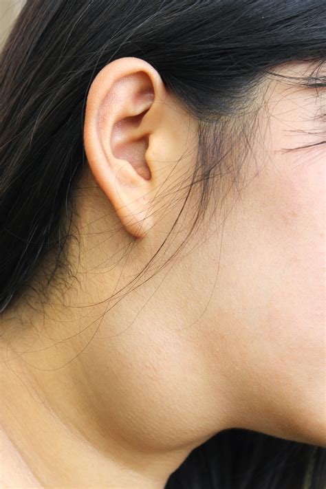 Neck mass (lump, growth) | doctorlansford.com