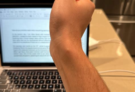 Hard inner lump on my wrist : r/medical_advice