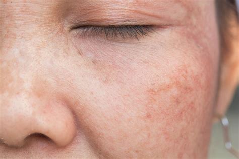 How To Get Rid Of Red Spots On Face Quickly - Having flawed skin is often stressful for people ...