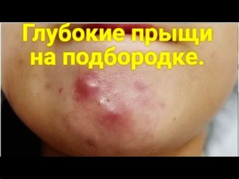 Прыщики на подбородке у женщины: причины почему постоянно появляются и ...