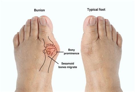 Bunions | Treatments, Causes, & Symptoms | CLS Health