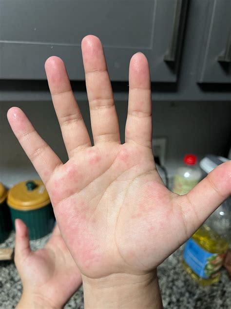 Anyone else get these red itchy bumps on their palms? : r/Hyperhidrosis