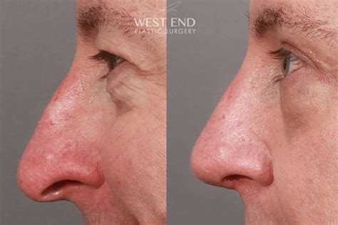 Septoplasty Only Before And After