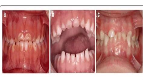 ATTRITION OF TEETH (Regressive Alterations of Teeth) | PPTX