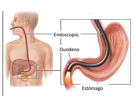 Gastroscopia: qué es , cómo se hace, para qué sirve - Consulta de Aparato Digestivo: Médico ...
