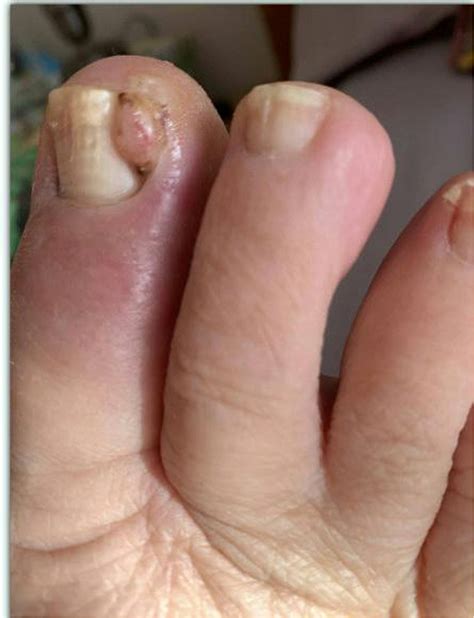 Salt as a Simple, Cost-Effective Treatment for Drug-Induced periungual pyogenic granulomas - EJC ...