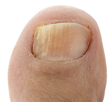 White Patches On Toenails - Causes, Signs & 5 Best Treatment