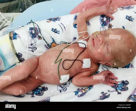 Premature baby 30 weeks hi-res stock photography and images - Alamy