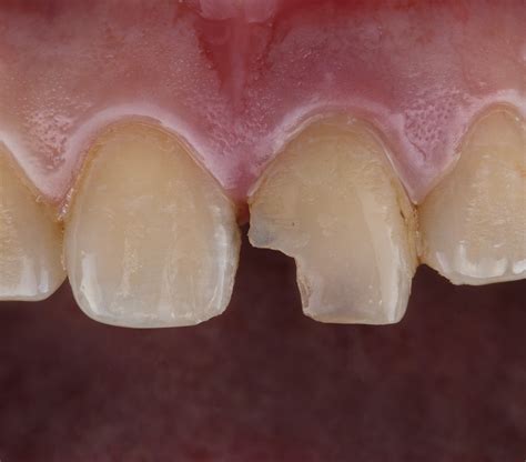 Chipped & Cracked Teeth Fixes: Forest & Ray's Expert Guide | Forest & Ray - Dentists ...