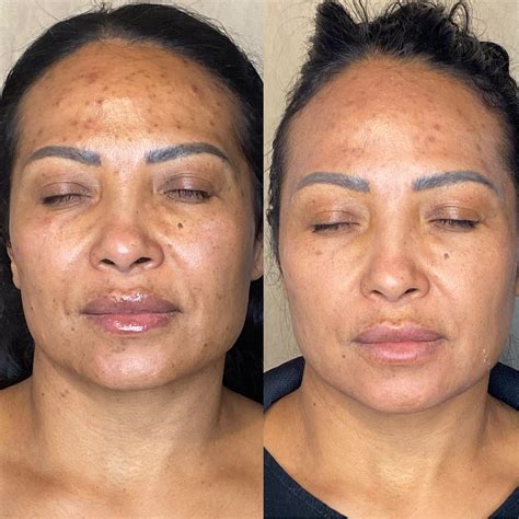 Microdermabrasion Before and After (Results + Pictures) - the daily glimmer