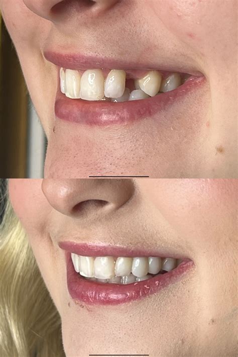 Cantilever Bridge Teeth - Cantilever Dental Bridges