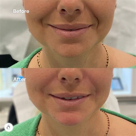 Filler Nasolabial Folds Before & After | Nasolabial folds, Liquid facelift, Skin firming