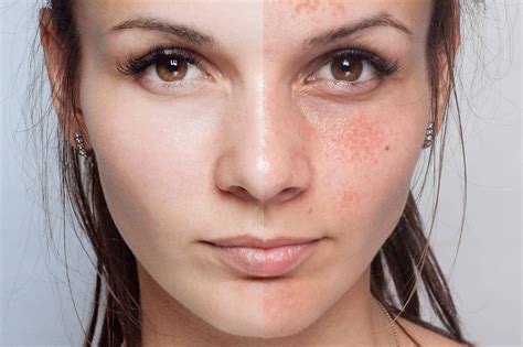 Skin Reset: Learn How to Get Rid of Blemishes on Face