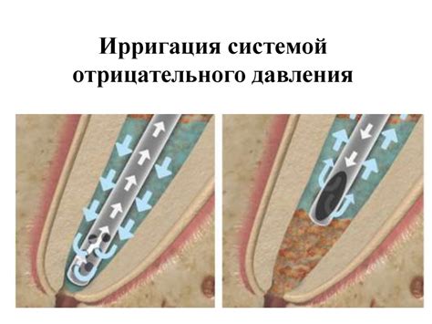 Ирригации корневых каналов - презентация онлайн