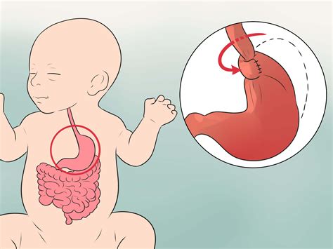 How to Treat Acid Reflux in Newborns: 11 Steps (with Pictures)