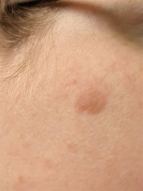 Anyone experienced with sunspots that become raised? more info in comments : r/DermatologyQuestions