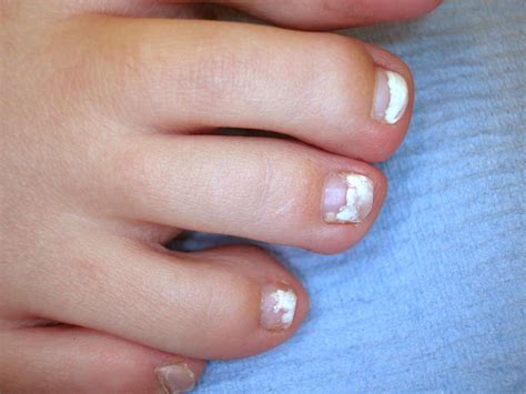 What Are the 4 Different Types of Toenail Fungus?