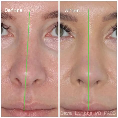 Septoplasty Before and After - Before After Journey