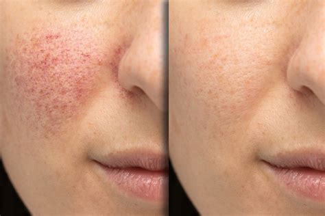 Видалення куперозу - Дерматологія та косметологія в Києві | NEW DERM ...