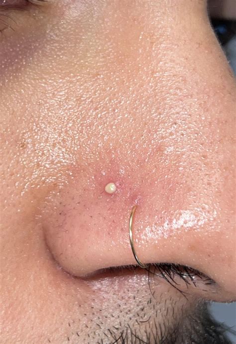 nasty lil white bump appeared on my nose yesterday. irritation bump ...