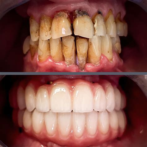 Advanced Gum Disease, Unsalvageable Teeth – The Solution: All‑on‑4