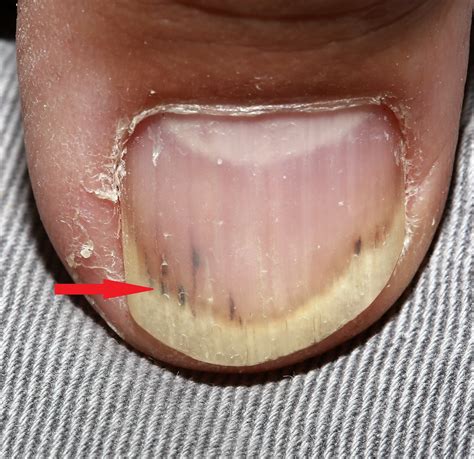 What To Do If You Get A Splinter Under Your Nail at Milla Hawthorn blog - splinter under fingernail