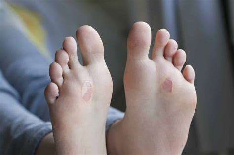 Foot Blisters | Foot Specialist Toronto | Feet First Clinic