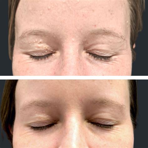 How To Remove Milia With Needle at Bennie Viveiros blog