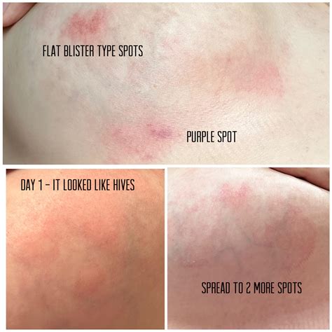 Keep getting sore red spots while breastfeeding. Thought it was a clog ...