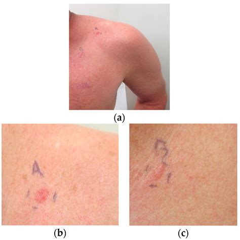 Basal Cell Carcinoma Early Stages