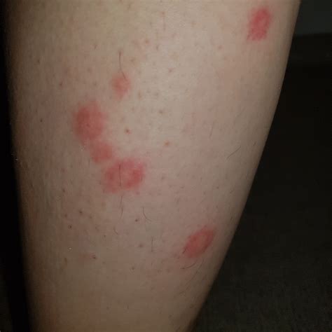 Bed Bug Bite Symptoms: How To Identify Bed Bug Bites – FNSHCX