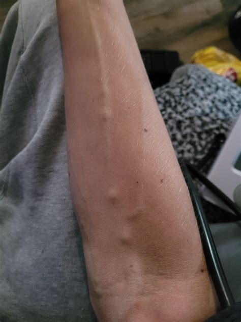 Bump in veins? : r/covidlonghaulers