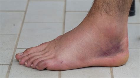 Inversion Ankle Sprain