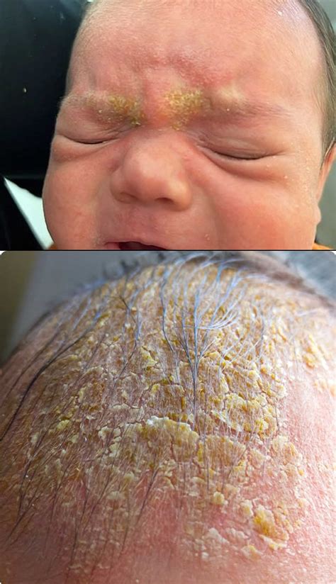Seborrheic dermatitis, causes, symptoms, diagnosis, treatment & prognosis