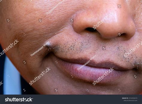 Asian Middle-aged Man Face Skin Diseasecloseup Stock Photo 1914533419 ...