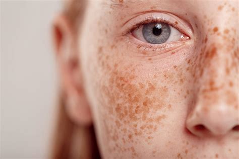Can Freckles Be a Sign of Skin Cancer?