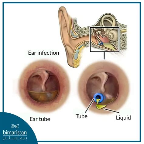 Eustachian Tube Dysfunction in the Ear and its Treatment