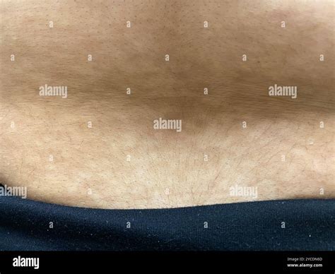 Confluent and reticulated papillomatosis on a 14 year old Hispanic ...