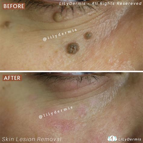 Seborrheic Keratosis Face Removal Seborrheic Keratosis Pennsylvania