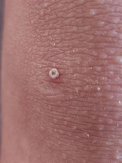 Raised nodule on son's knee : r/Dermatology