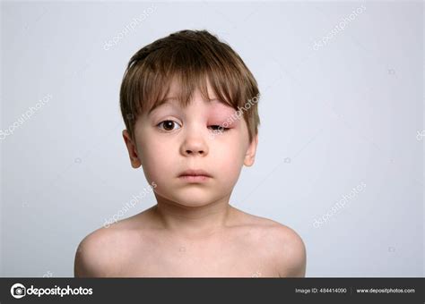 Boy Swollen Eye Insect Bite Quincke Edema Portrait Caucasian Appearance ...