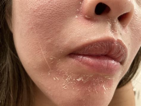How To Get Rid Of Dry Flaky Skin Around Nose And Mouth at Bobby Mosca blog