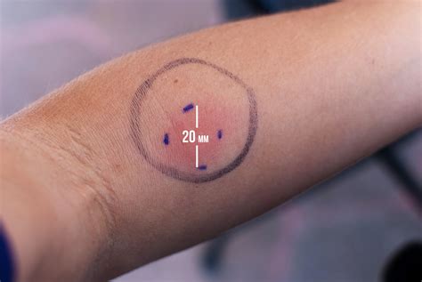 Tb Skin Test Ruler Printable, Web mantoux tuberculin skin testing rulers.