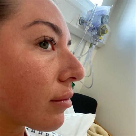 Septorhinoplasty | Deviated Septum | Pall Mall