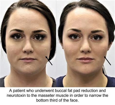 Buccal Fat Pad Removal Montgomery AL | Alabama Surgical Arts