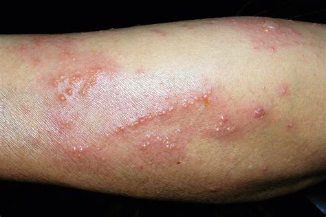 Poison Ivy, Oak, and Sumac Allergies: Symptoms, Diagnosis, Treatment