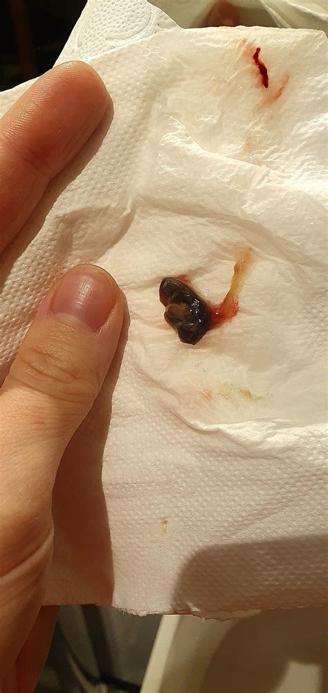 Blood Clots In Nose Causes Nosebleeds (Epistaxis) With Clots: Causes