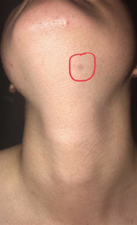 Porque Salen Bolitas En El Ano - docksidetrust