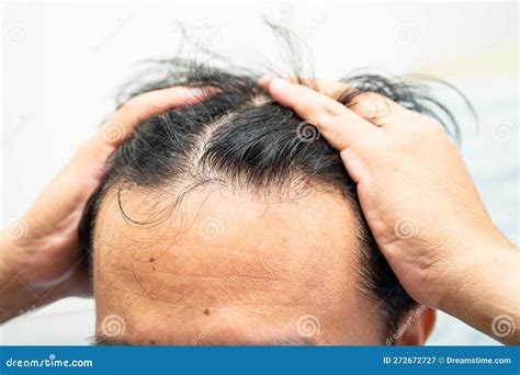 Bald At Front Of Head And Begin No Loss Hair Glabrous Of Mature Asian ...